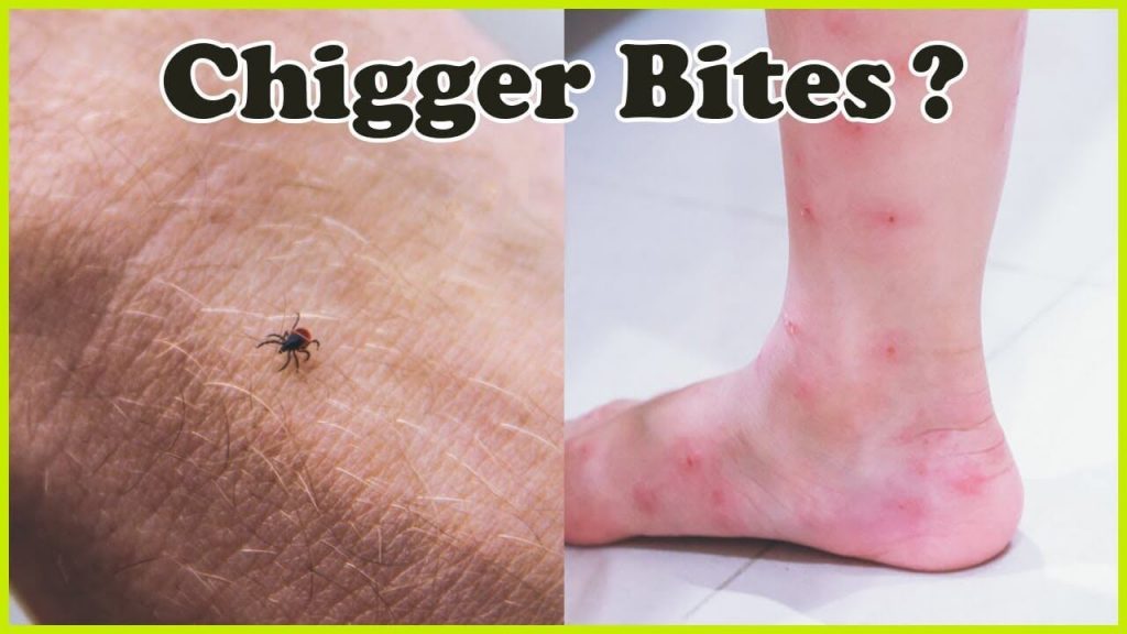 How Long Do Chigger Bites Keep Itching